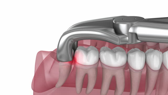 What to Know Before Getting a Wisdom Tooth Removal in Adelaide