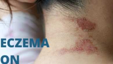 Photo of Is Eczema Contagious: What Causes it to Spread?