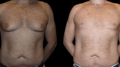 Photo of Empowering Choices: Male Breast Reduction Options in Dubai