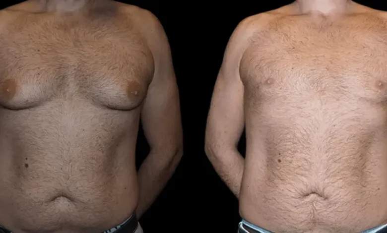 male breast reduction with before and after phots