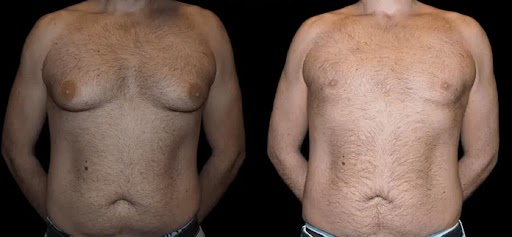 before and after male breast reduction results