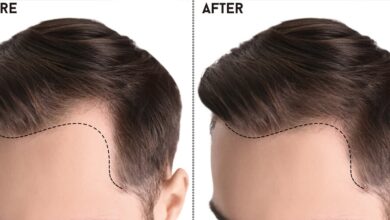 Photo of The Ultimate Guide to Hair Transplants in Islamabad